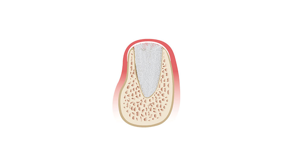 cm1401-atraumatic-extraction-01c