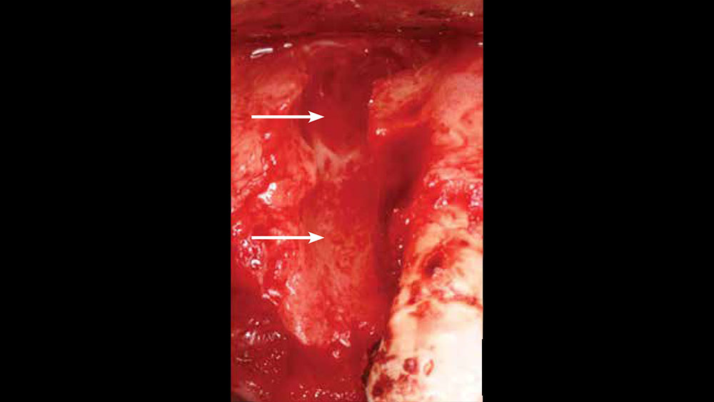 cm1401-atraumatic-extraction-03a