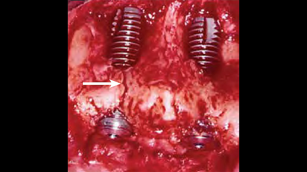 cm1401-atraumatic-extraction-03b