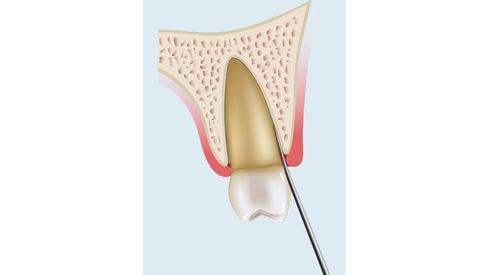 cm1401-atraumatic-extraction-08a