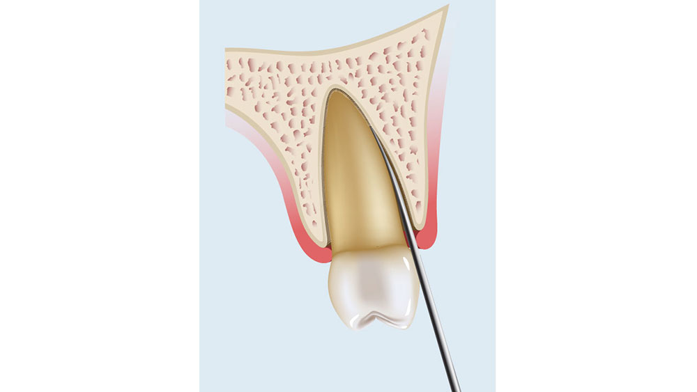 cm1401-atraumatic-extraction-08b