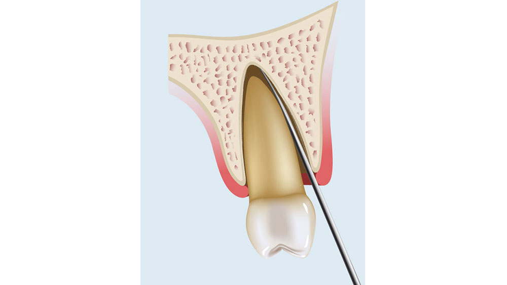 cm1401-atraumatic-extraction-08c