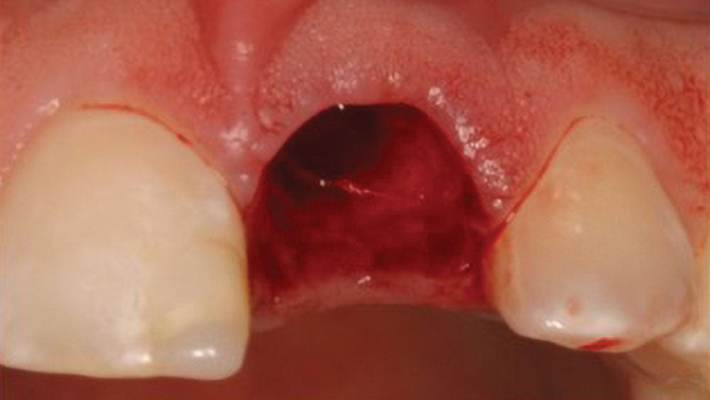 cm1401-atraumatic-extraction-04a