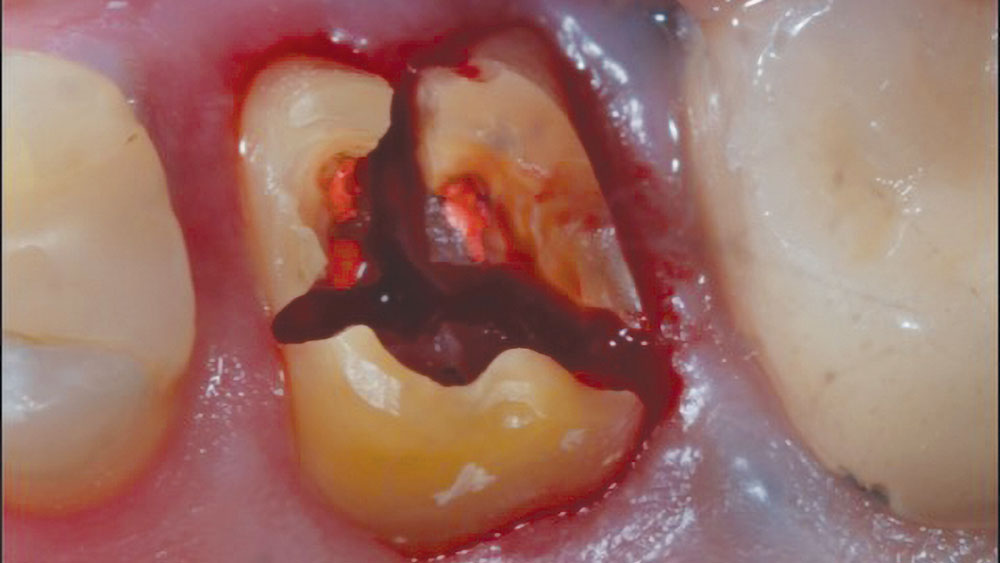 cm1401-atraumatic-extraction-05a