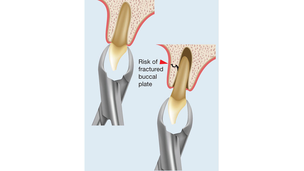 cm1401-atraumatic-extraction-02