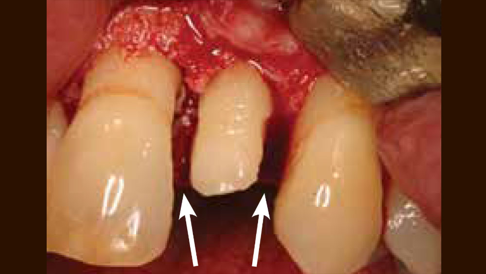 cm1401-atraumatic-extraction-06