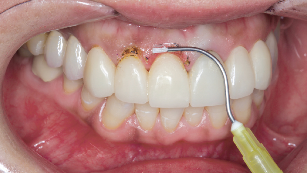 patient is provisionalized with BioTemps® temporary restorations