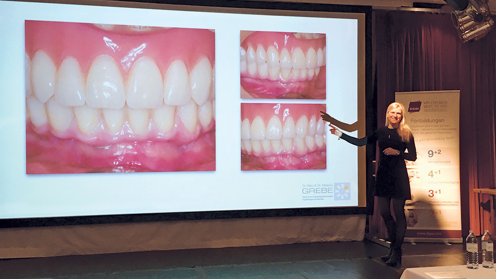 Dr. Melanie Grebe showed how a BruxZir® Full-Arch Implant Prosthesis restored the oral health of a patient who was struggling with a poorly fitting lower denture