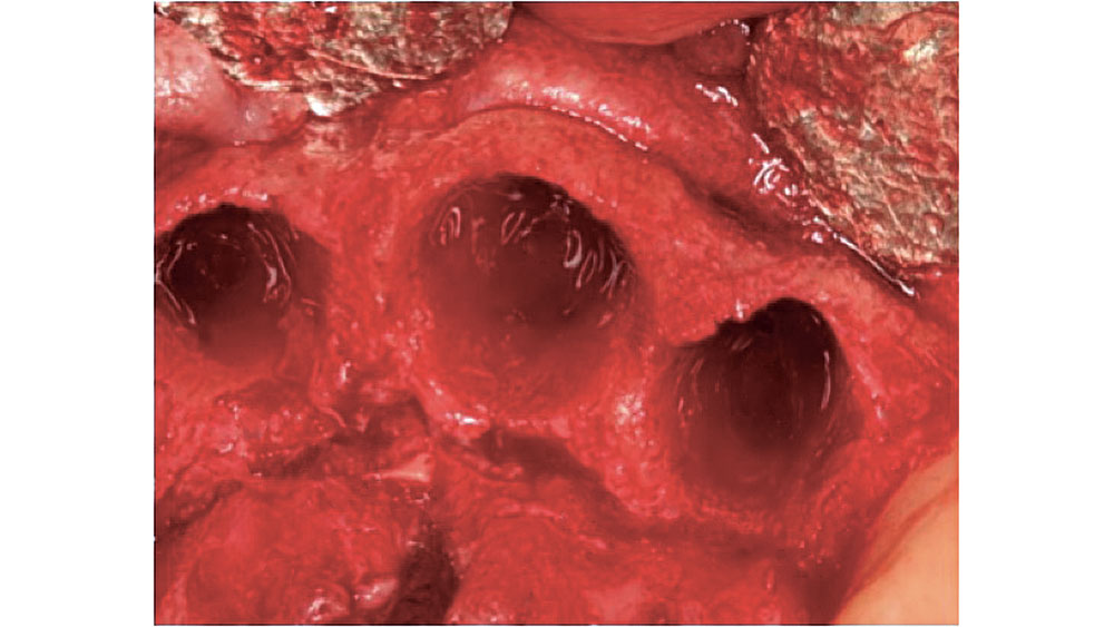 Figure 2: Five-walled extraction socket