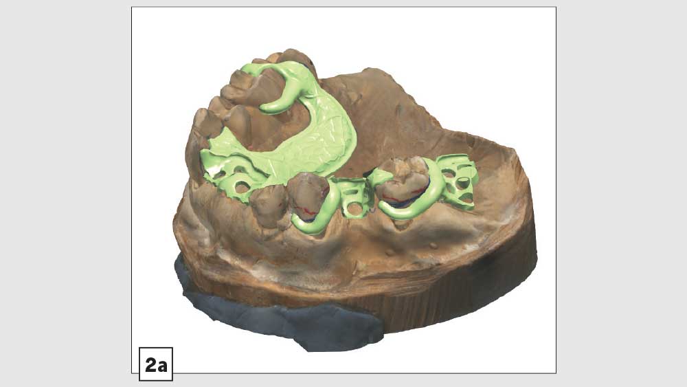 digital scan and design of acetal frame using dental CAD software