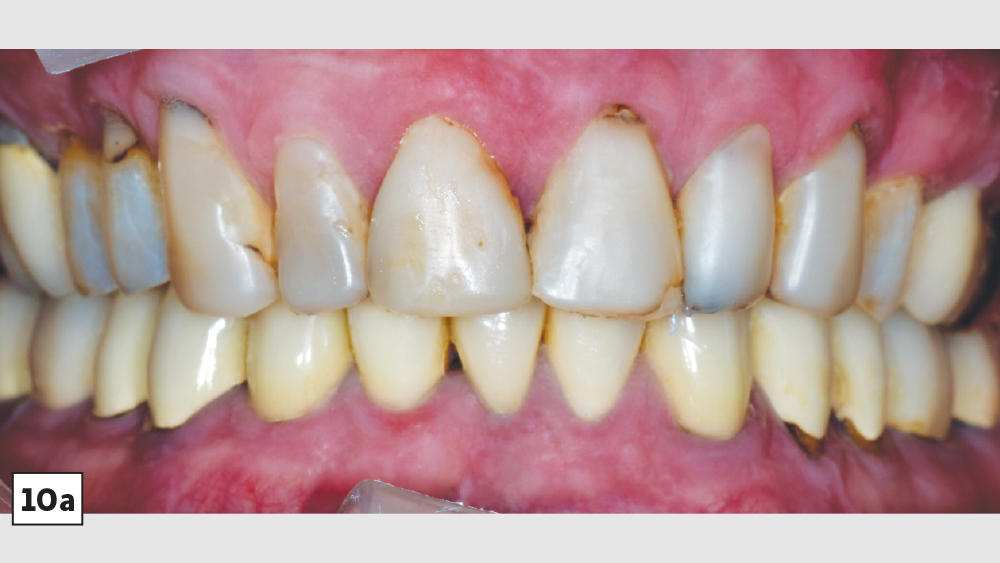 Before image of patient's teeth