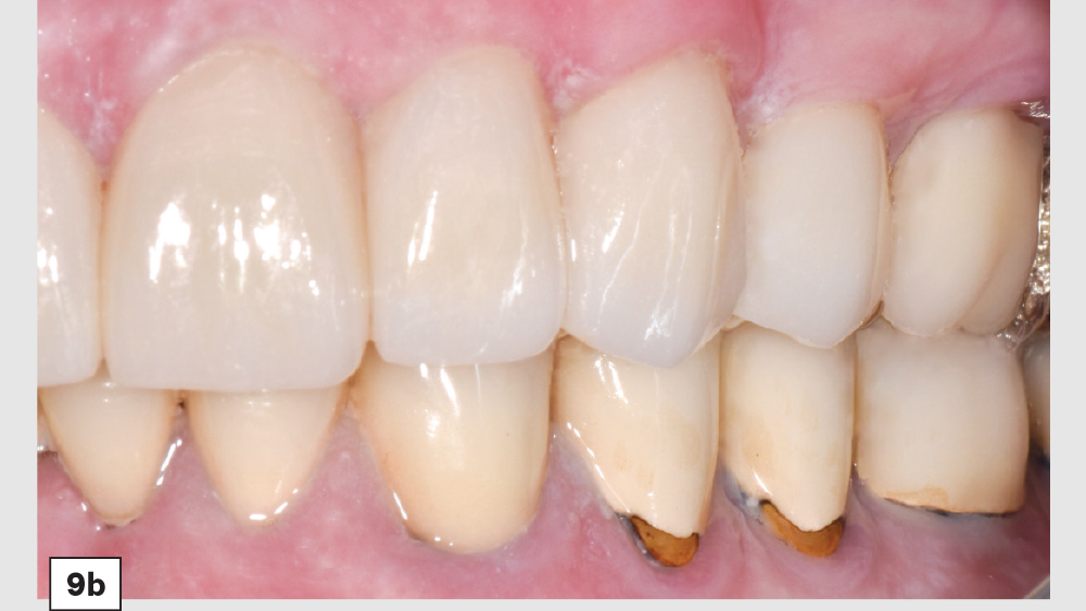 Improvement on patient's teeth with BruxZir Esthetic restorations