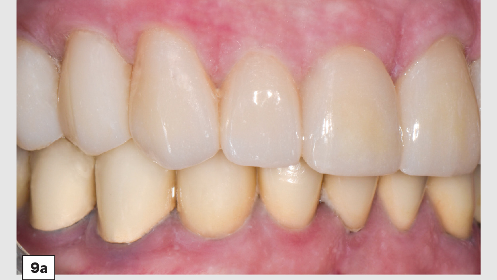Improvement on patient's teeth with BruxZir Esthetic restorations