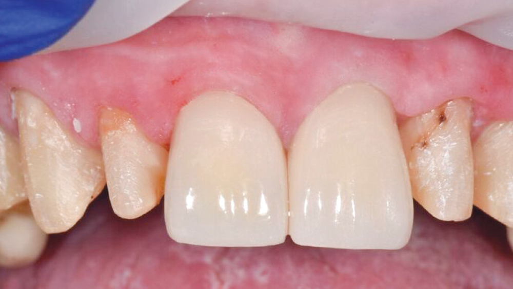 Restorations were seated on teeth #8-9
