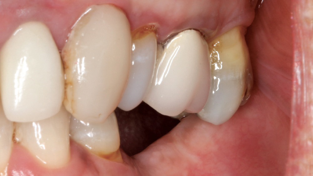 patient's edentulous space in area tooth #19 