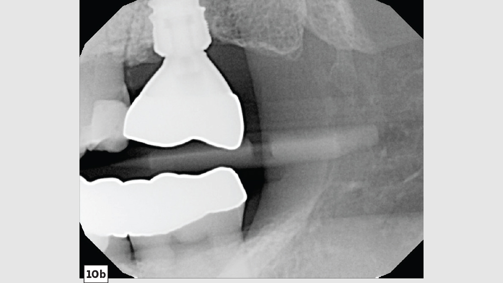 figure 10b: final restoration is seated and delivered as a screw-retained crown shown in x-ray