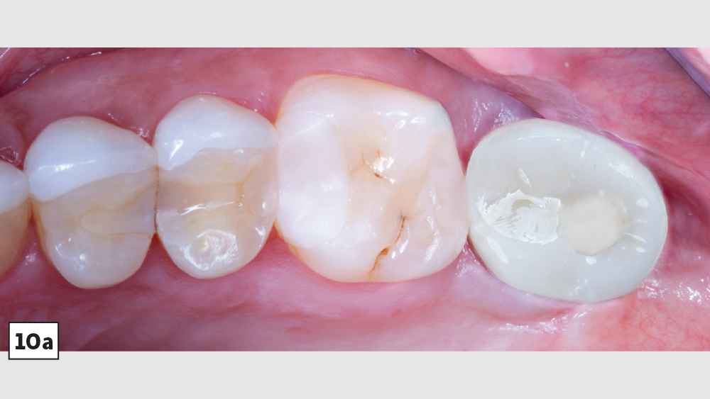 figure 10a: final restoration is seated and delivered as a screw-retained crown