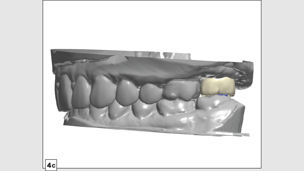 figure 4c: digital design crown designed with narrow occlusal table and minimal cuspal heights