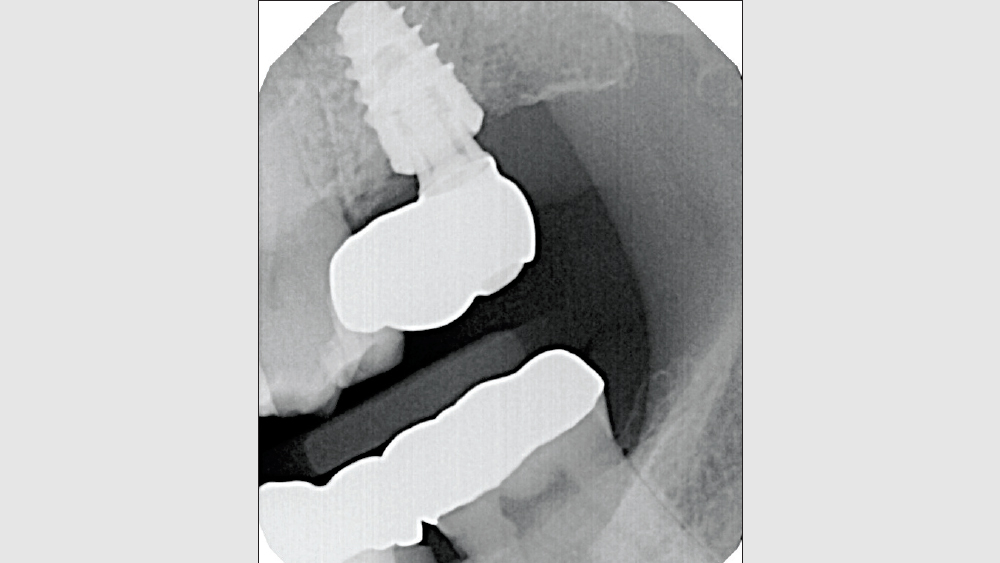 figure 1: patient x-ray with existing screw-retained crown