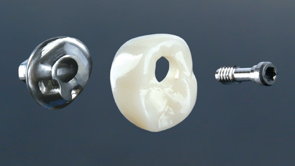 figure 5: inclusive titanium custom abutment and bruxzir full-strength crown milled from CAD design
