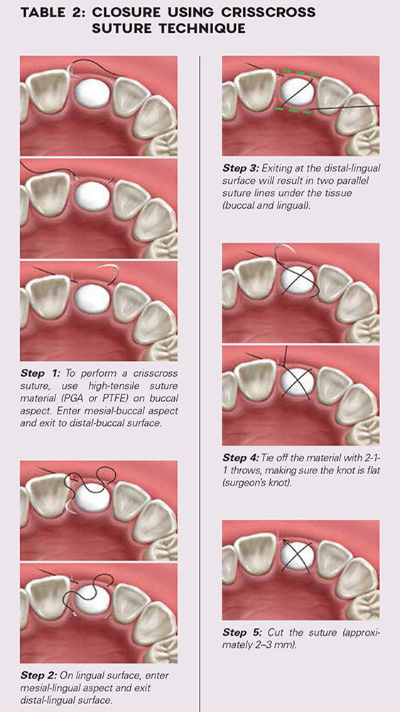 Table 2: Closure Using Crisscross Suture Technique