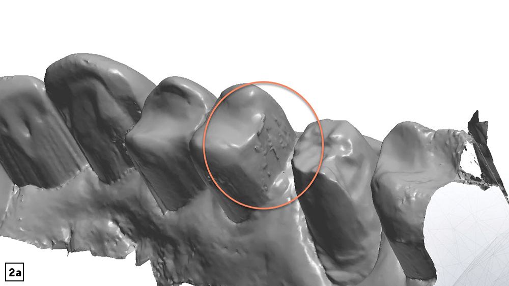 Digital impression of too much moisture which displays misleading shapes and textures of teeth