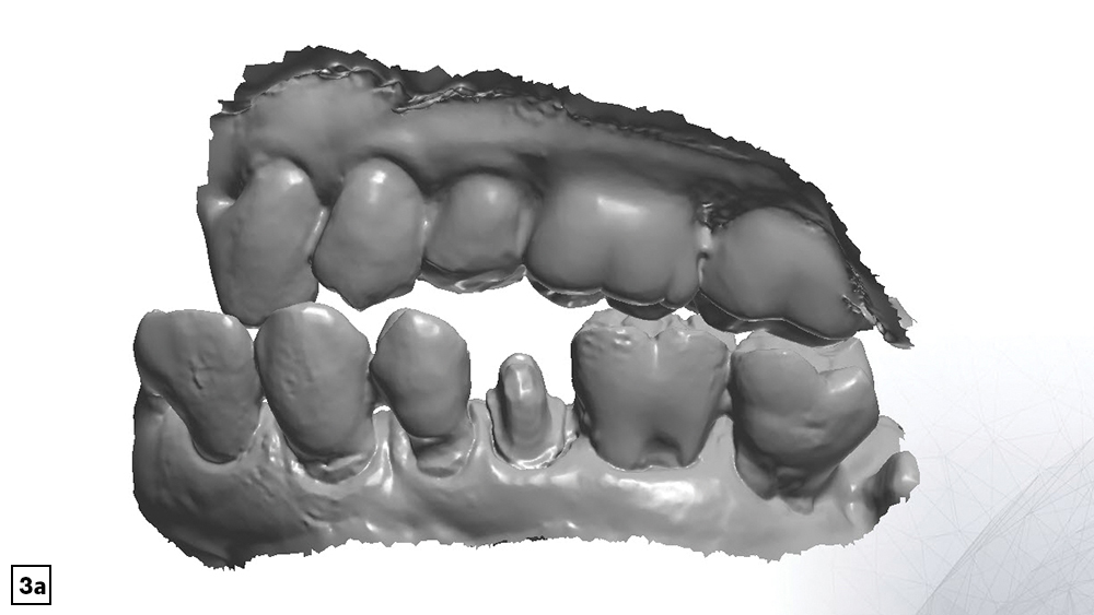 Unnatural or abnormal bite on patient's part results in inaccurate buccal scan
