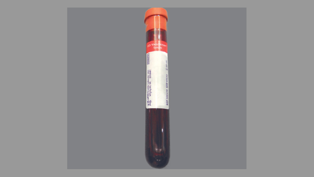 Blood sample in vial