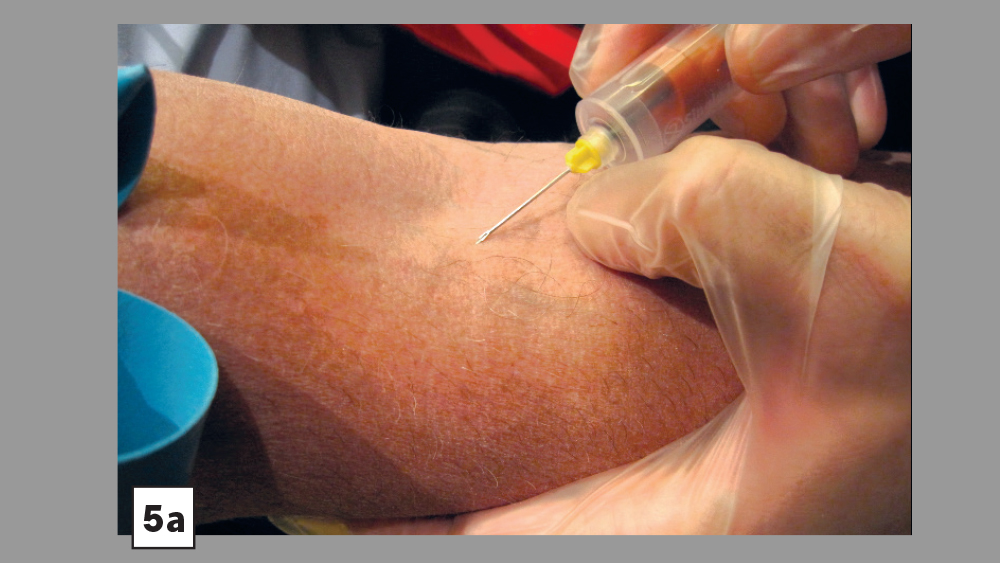 Skin being pulled for needle injection