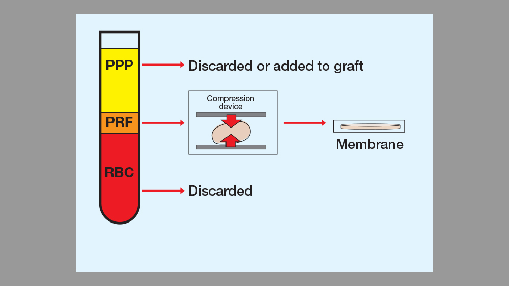 PRF processing infographic chart