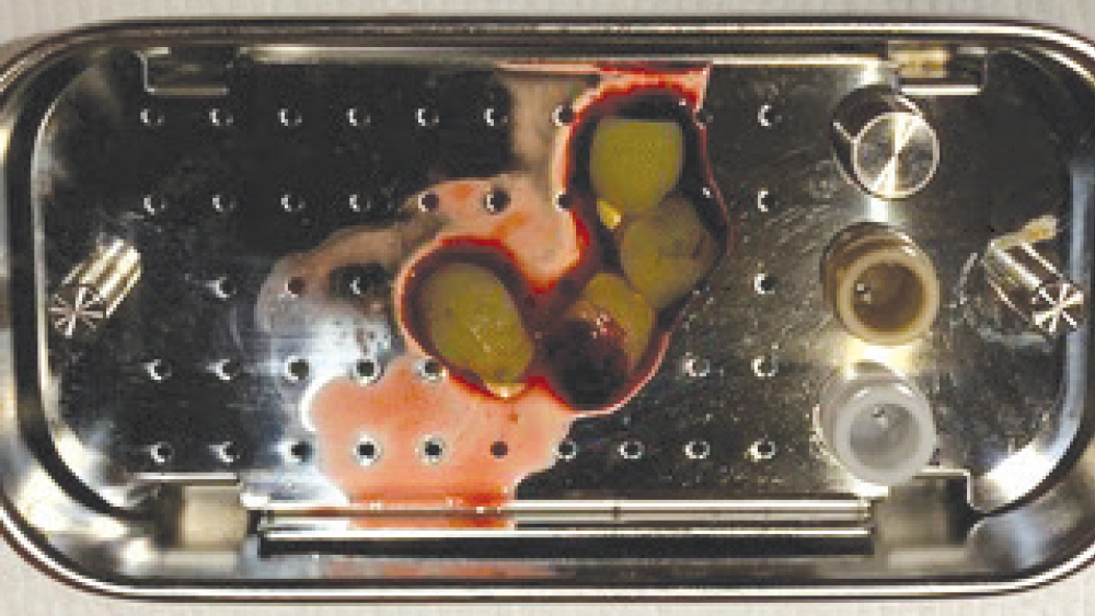Fibrin clots placed in PRF box