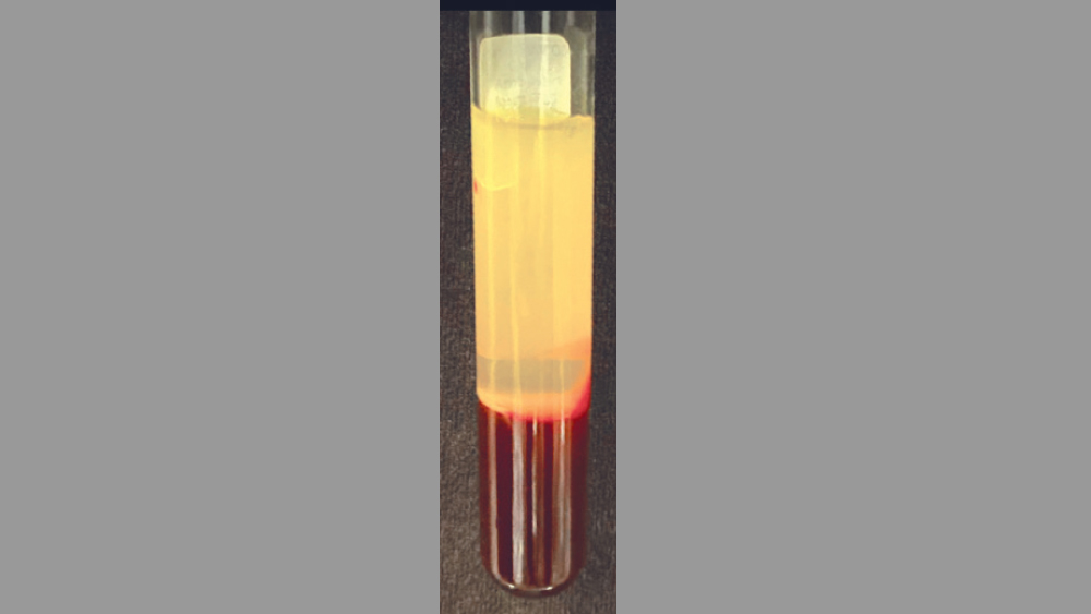 Three distinct layers are present in vial: acellular platelet-poor plasma, PRF clot in the middle and red blood cells on the bottom