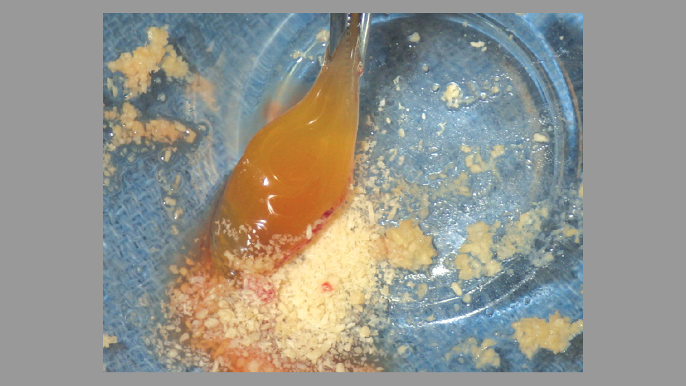 PRF used to hydrate the graft material
