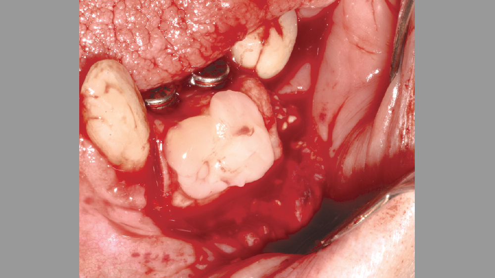 PRF used as a membrane after implant placement