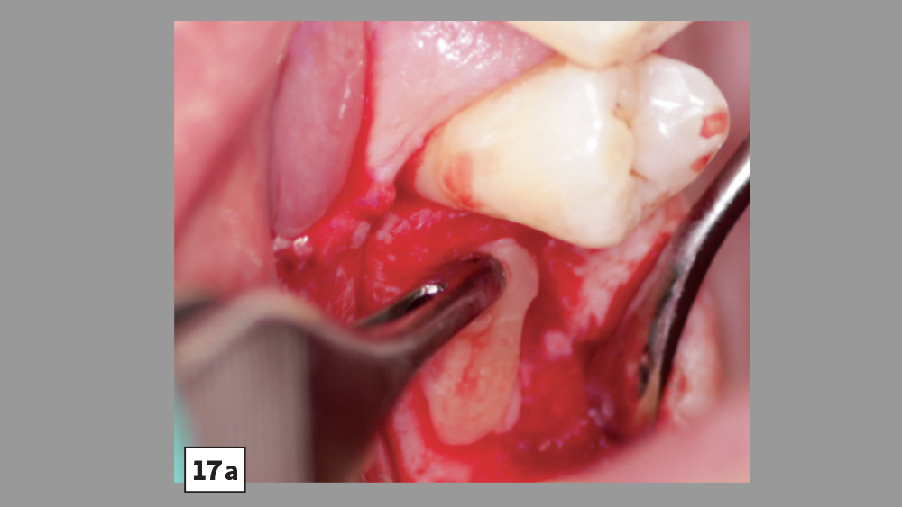 PRF used with crestal-approach sinus augmentation