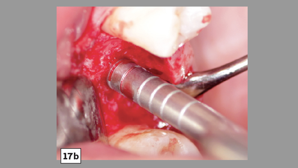 PRF used with crestal-approach sinus augmentation