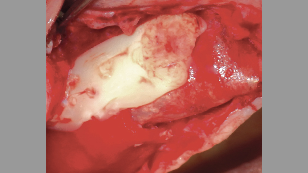 PRF used over lateral wall sinus augmentation