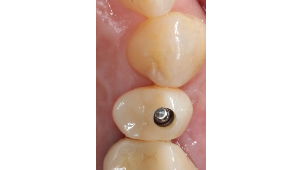 Screw-retained crowns were sealed with composite on implant site different viewpoint