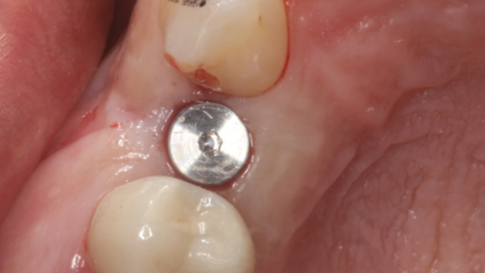 Close-up of 3-mm-tall healing abutment