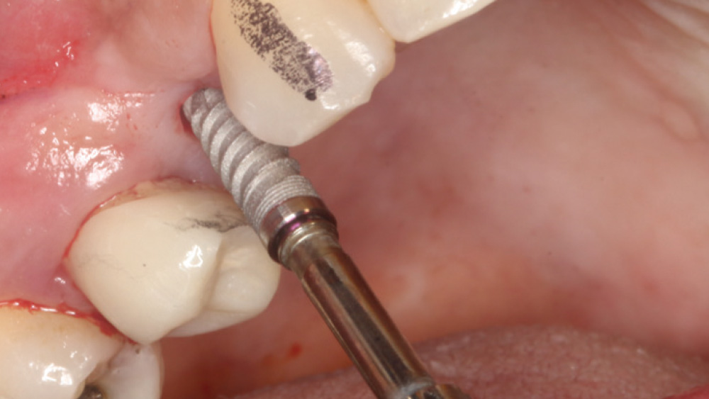 3.5 mm Hahn implants were threaded into position