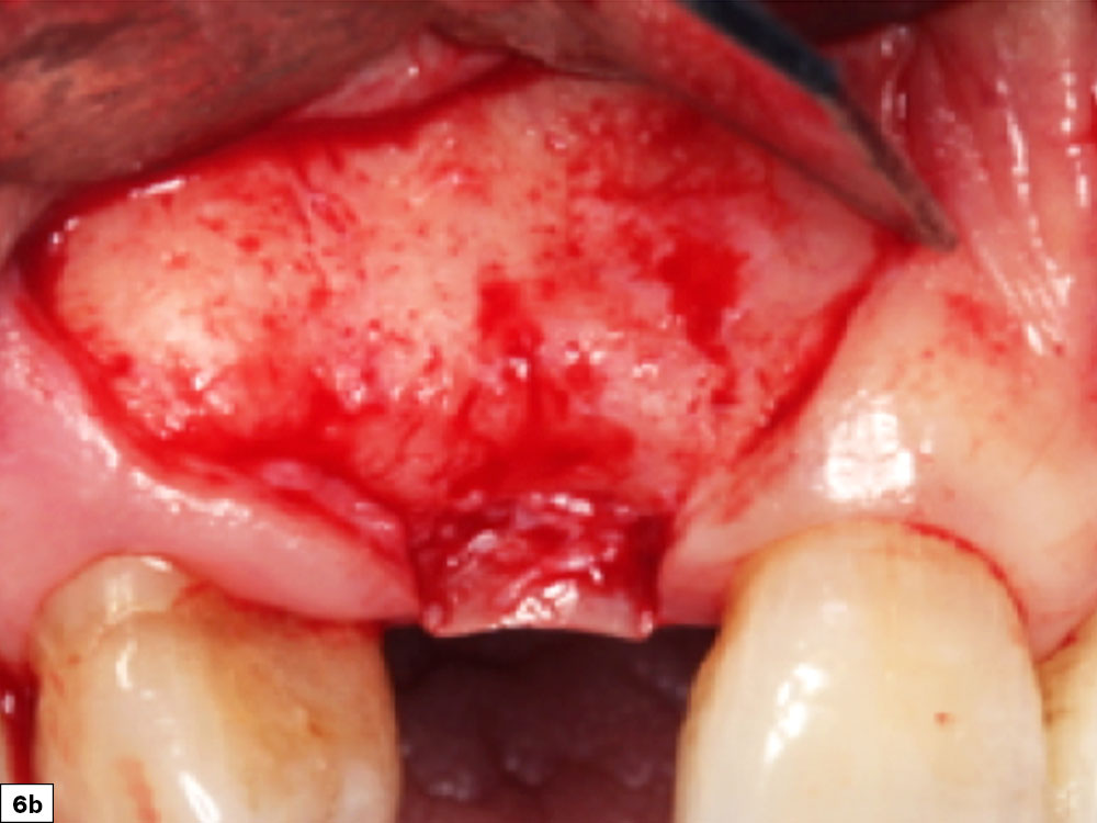 Papillae-sparing incision prevents postoperative tissue recession