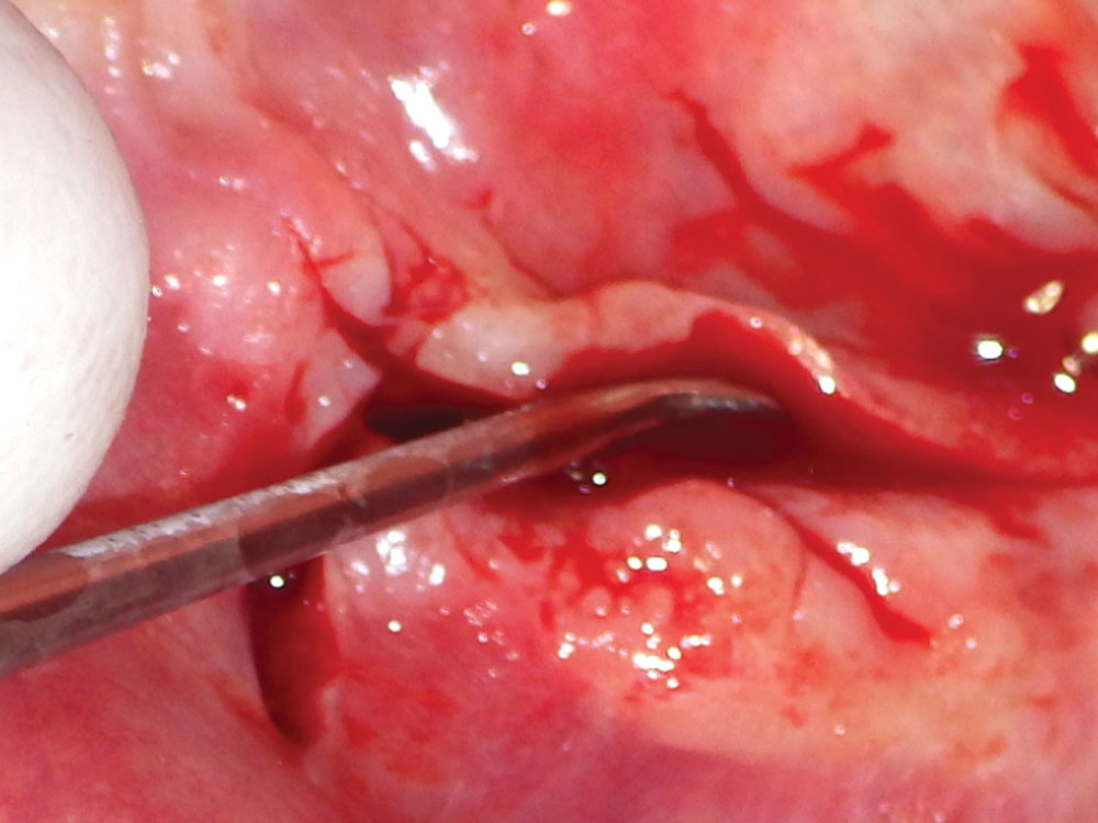 Tissue reflection: Use of a 2/4 molt curette, which allows for nontraumatic soft-tissue exposure