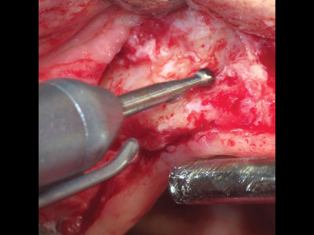 Soft-tissue removal with No. 8 round carbide bur