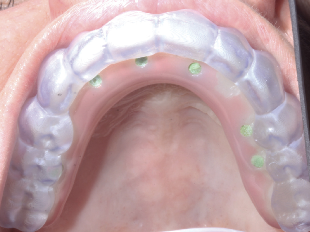 Comfort3D Bite Splint and BruxZir® Implant Prosthesis under view of upper arch CSMV16I1 
