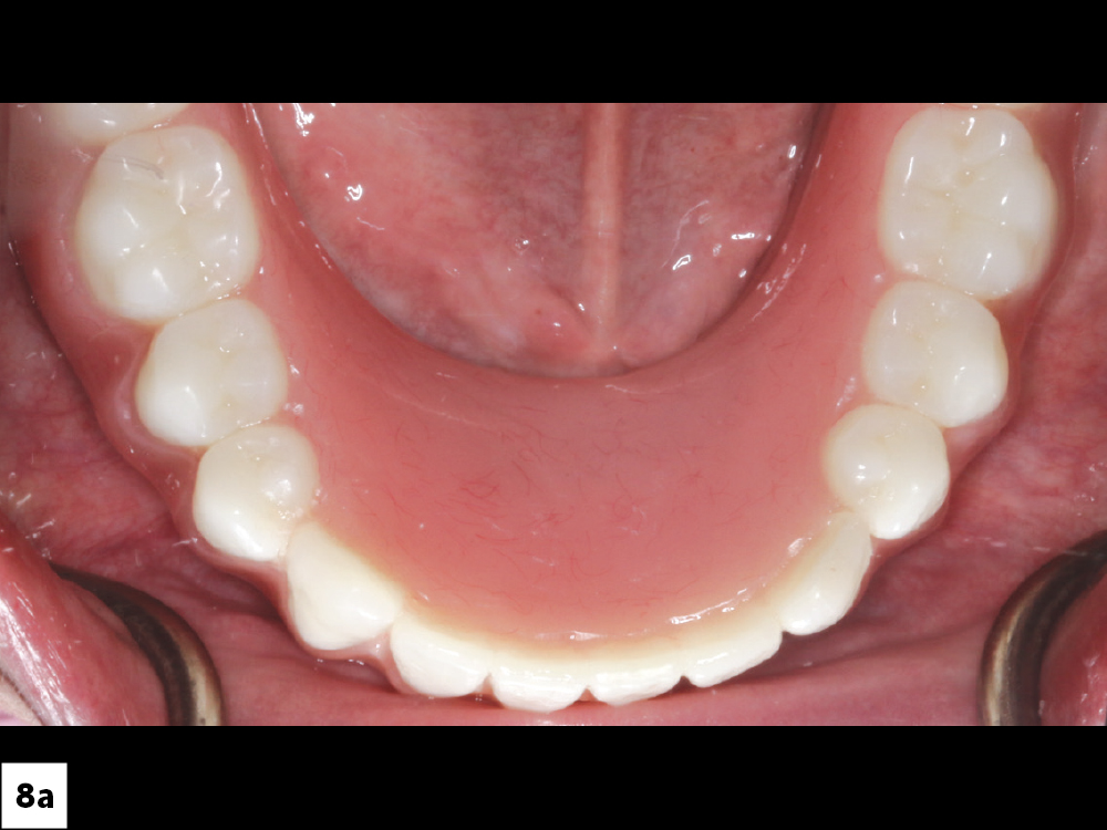 Figure 8a Implant-retained mandibular overdenture