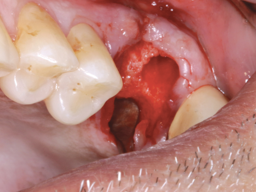 Socket of removed tooth