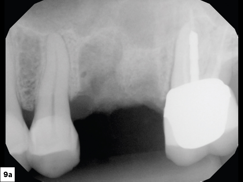 Figure 9a Replacement of a Maxillary First Molar CSM V16I3