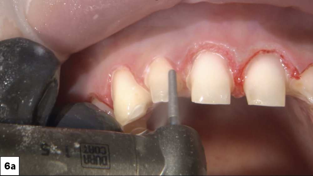 Figure 6a: Beginning prep with tooth #6 