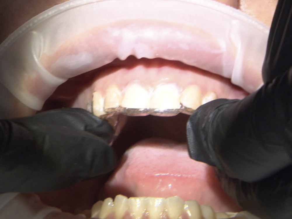 Figure 4: Checking gingival contours on BioTemps Restorations