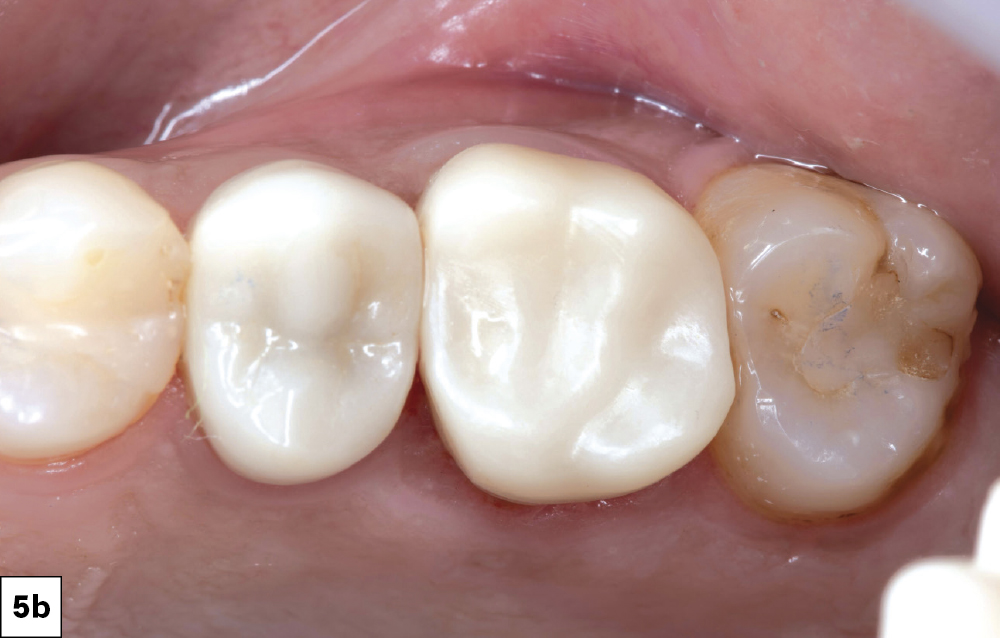 Figure 5b: BruxZir® NOW fully sintered zirconia being used as the final restoration